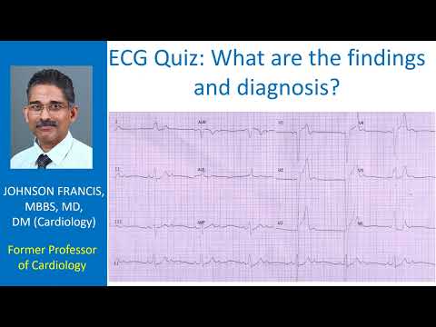 ECG Quiz: What are the findings and diagnosis?