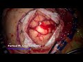 Brain tumor surgery: Large brain tumor (glioblastoma  multiforme) is being resected.