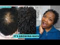 CCCA HAIR LOSS JOURNEY UPDATE || CCCA ALOPECIA