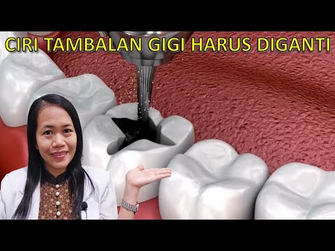 Video: 3 Cara untuk Mengetahui Apakah Tambalan Gigi Anda Perlu Diganti