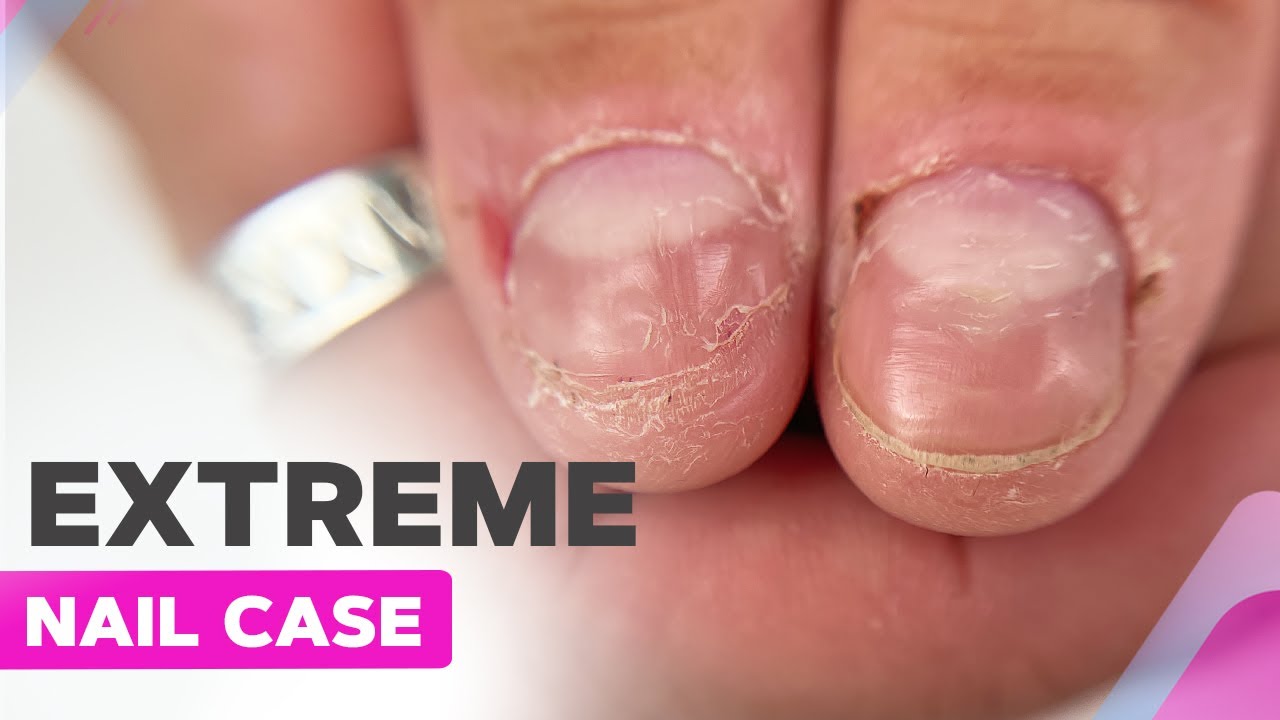 Why Do My Nails Hurt After A Manicure?