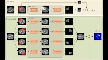 [P083] Patched Diffusion Models for Unsupervised Anomaly Detection in Brain MRI
