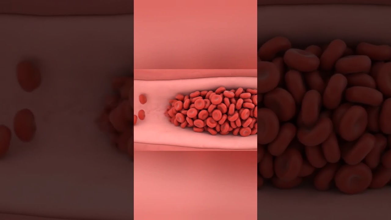 Sickle Cell Anemia: When Blood Cells Lose Their Shape