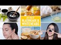 Easy Ways To Remove Blackheads And Whiteheads At Home