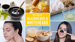 Easy Ways To Remove Blackheads And Whiteheads At Home screenshot 1