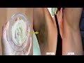 5 Minutes Remedy to Get Rid of Dark Underarms |Effectively 100%