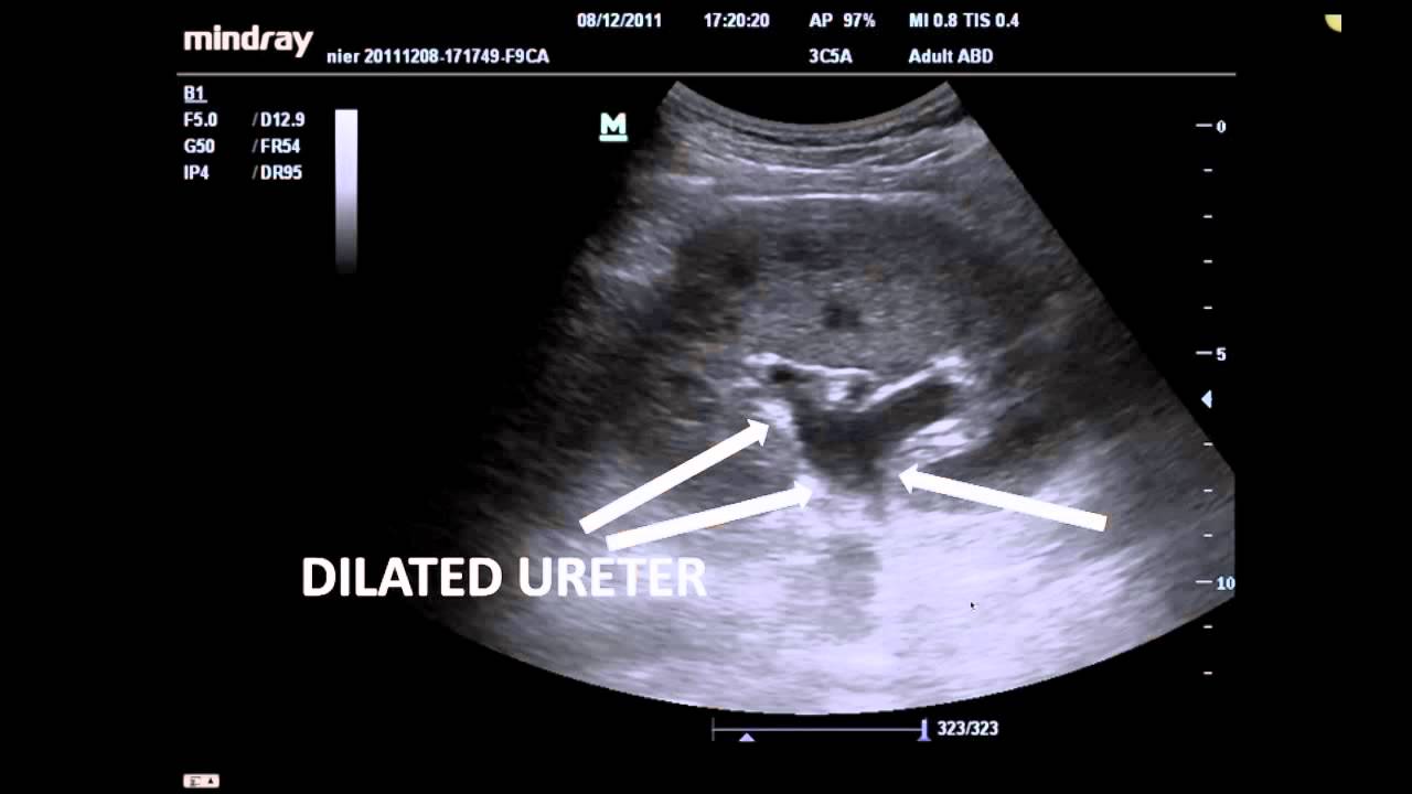 ABDOMINAL ULTRASOUND CASE 1- MINDRAY - YouTube