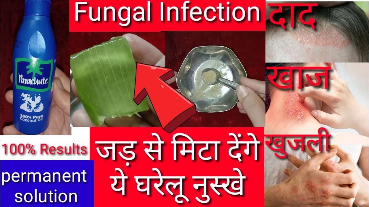 Daad Ka IlajDaad Khaj Khujli Ka IlajFungal Infection On SkinRingworm