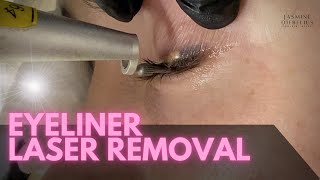 Eyeliner Removal - Laser Treatment by Jasmine Diebelius 3,037 views 1 year ago 5 minutes, 59 seconds