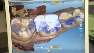 Cerec 3D Crowns | Same Day Crowns | Redondo Beach Dental Group