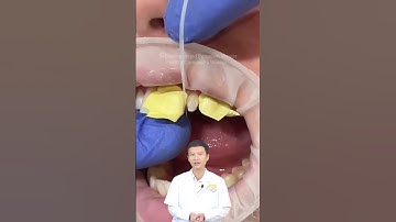 Mất răng, mẻ răng thì phải làm sao?! | Nha Khoa Minh Châu