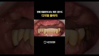 [부산전체임플란트] 전체임플란트가 어려운 케이스도 디지털 풀아치는 가능!? #dentalclinic