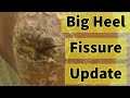 Big Heel Fissure Update: The Heel Has Finally Healed!