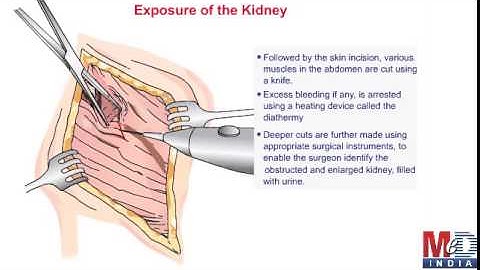 Pyeloplasty of Kidney
