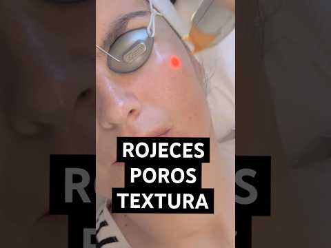 Rojeces, poros, textura… el láser que lo cambia todo