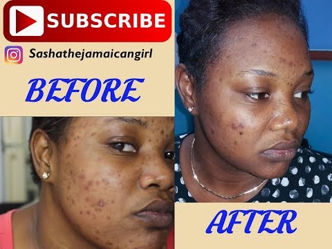 How to get rid of acne spots and dark marks fast!- Microdermabrasion treatment