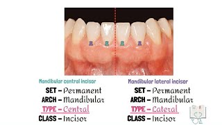 Differences between Mandibular Central & Lateral Incisor