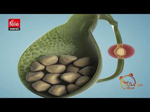 تعرفوا على مخاطر حجر المرارة وما يجب تجنبه من الأطعمة