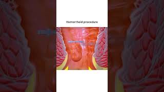 Hemorrhoid Procedure