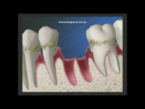Video: Dip Gum Disease, Perdita Dei Denti E Altri Effetti