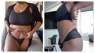 Sono Bello - What To Expect - My Liposuction Experience Final Results 