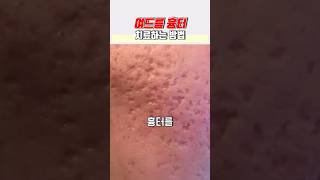 여드름 흉터 치료하는 방법 #패인흉터 #박스카 #박스흉터 #boxcar #boxscar