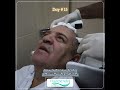 How to remove scabs after a hair transplant  hairextrem hair transplant center
