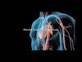 Aortic Aneurysm and Aortic Dissection