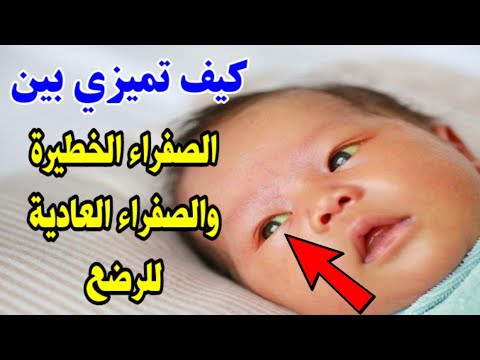 كيف تميزي بين الصفراء الخطيرة و الصفراء الطبيعية الفيزيولوجية عند حديثي الولادة والعلاج الوحيد اها