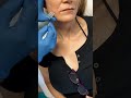 Smooth PDO Threads  Fountain Hills Arizona TikTok Ver   NeckLift and Facelift   Dr. K MedSpa   Arizo