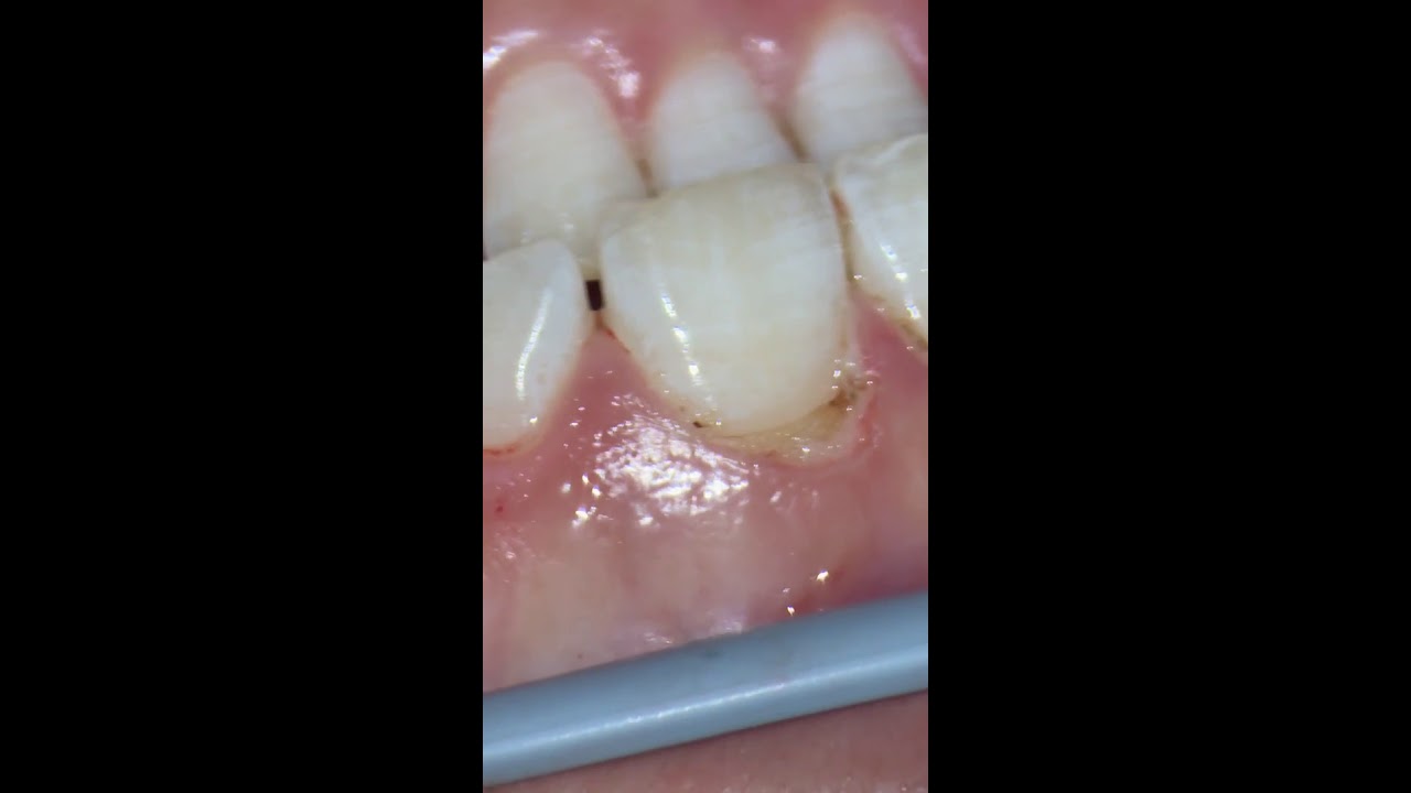 Diode Laser gingivectomy YouTube
