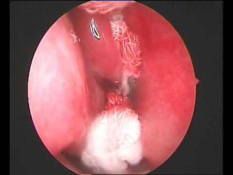 Lobular Capillary Hemangioma of Right nasal cavity