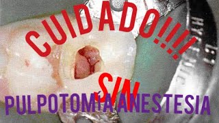 HORROR!! PULPOTOMÍA sin Anestesia!!!! CUIDADO!!!! by ESPECIALIDADES ODONTOLOGICAS 4,104 views 2 years ago 5 minutes, 27 seconds