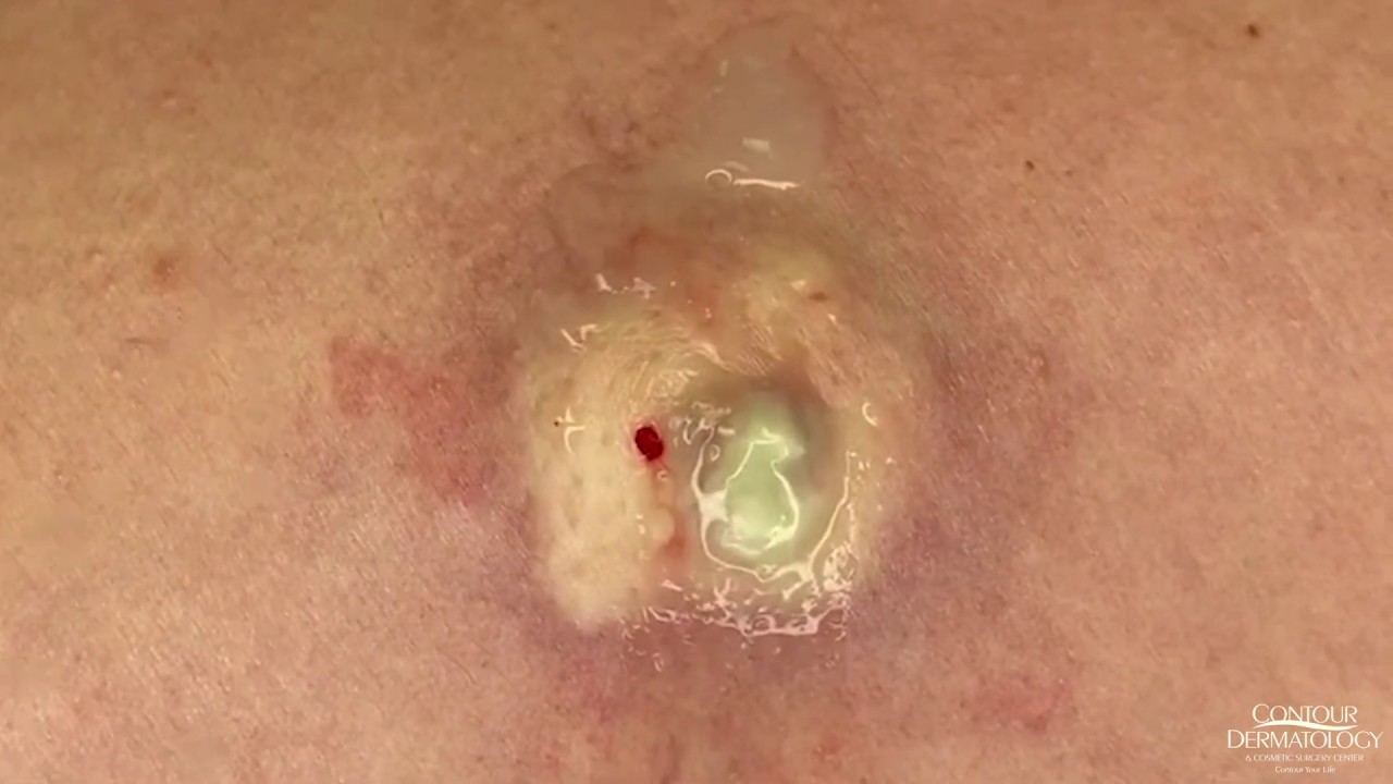 Cyst (Chicken and Oysters) Extraction &amp; Squeeze