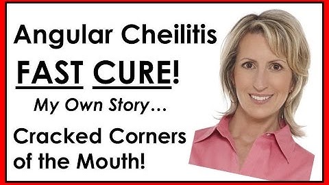 Angular Cheilitis FAST CURE - Gone Quickly!