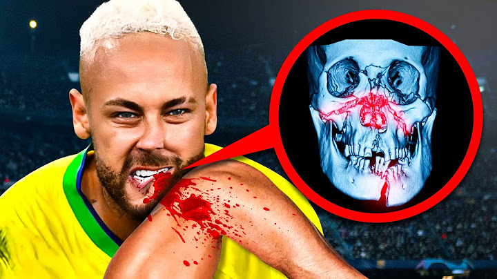 FOTBALISTI, Kteří Hráli s VÁŽNÝM ZRANĚNÍM…