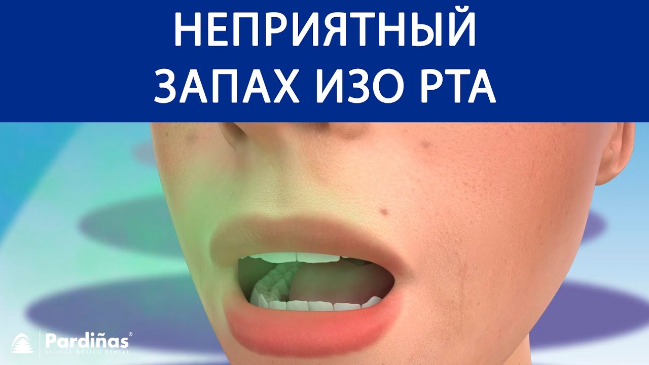 Неприятный запах изо рта. Неприятный запах изо рта причины. Запах изо рта при панкреатите. Сладкий запах изо рта