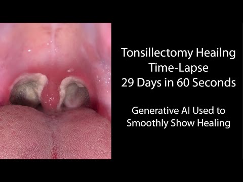 Video: A largohet tonsiliti?
