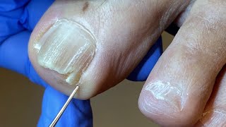 OJO! Deja un arpón al cortar su uña, no cometas este error #nails #foot #viral