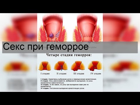 Секс при геморрое