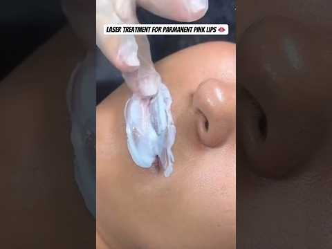 Laser Treatment for Permanent Pink lips 👄🩷#pinklips #lips #treatment #laser