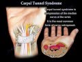 Carpal Tunnel Syndrome - Everything You Need To Know - Dr. Nabil Ebraheim