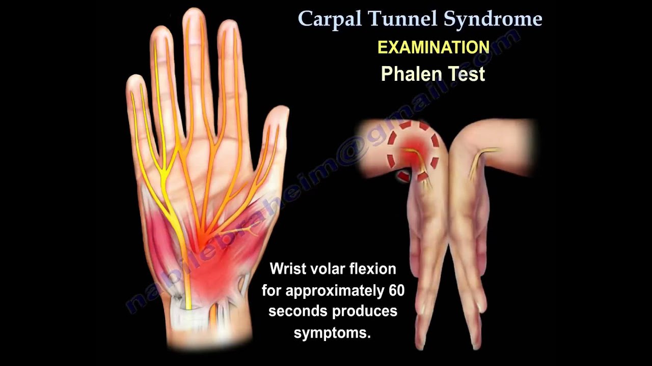 Carpal Tunnel Syndrome