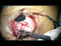 Superior Rectus Recession (conventional method)