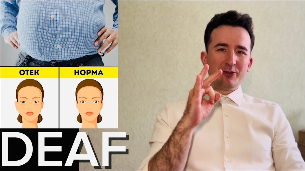 Отёки : причины, факторы риска, сигналы тела. Для глухих. #deaf #sign #ржя 