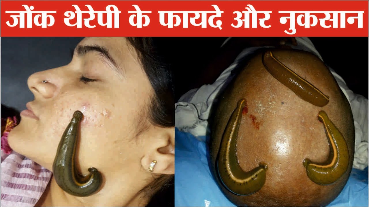 जोंक थेरेपी के फायदे और नुकसान Leech therapy benefits Jonk therapy
