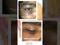 Infraorbital Rim Fracture Repair | Minimal Scar Technique