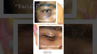 Infraorbital Rim Fracture Repair | Minimal Scar Technique