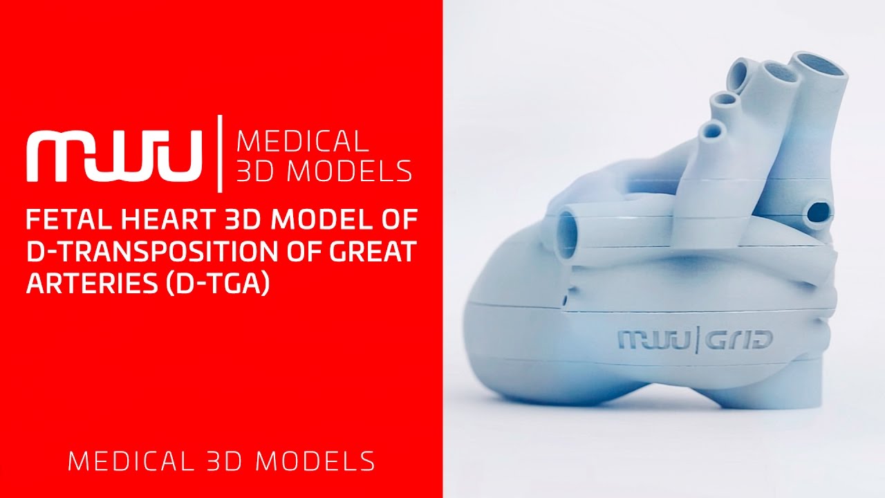 MWU 3D Models: d-Transposition of Great Arteries (d-TGA) 3D model with axial sections.