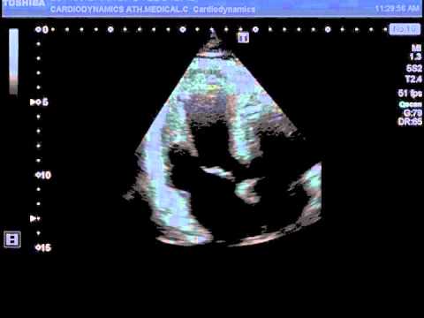 Left Ventricular Apical Thrombus - YouTube